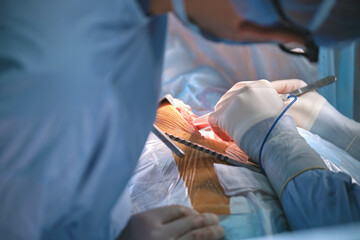 Closeup of professional doctor hands operating a patient during open heart surgery in surgical...