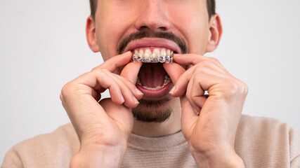 Male hand applying dental aligner retainer of dental clinic for teeth treatment - obrazy, fototapety, plakaty