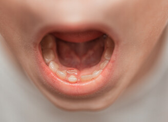 Eruption of a permanent tooth against the background of milk teeth. Changing teeth. Smomatology. Medical concept.