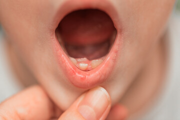 Eruption of a permanent tooth against the background of milk teeth. Changing teeth. Smomatology. Medical concept.