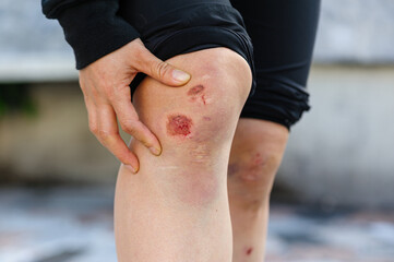 Sports injury, skateboarder with injured knees