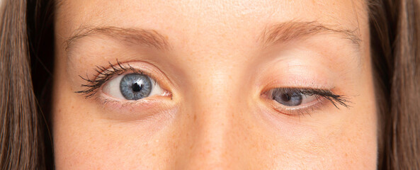 Young woman with strabismus and floppy eyelid syndrome