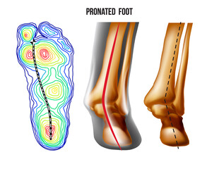 Pronated foot, arch deformation, bottom and back view . Foot weight distribution.