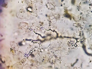 Microscopic image of dermatophytes. Skin scraping for fungus test