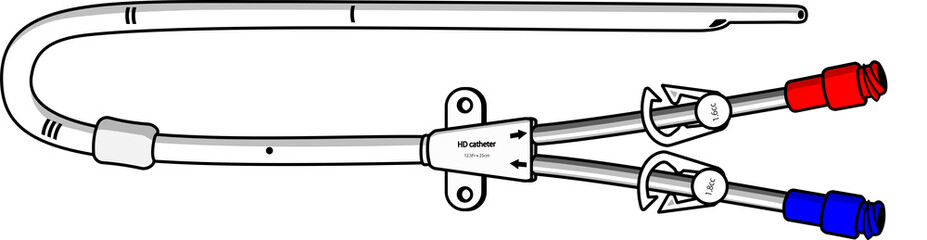 血液透析用ダブルルーメンカテーテル(tunneled)のイラスト
