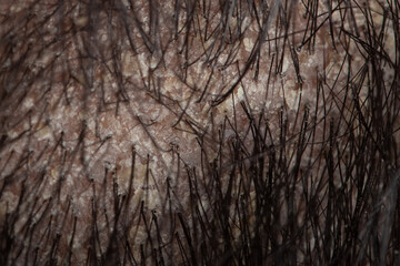hair root scalp with oily flaky dandruff, seborrheic dermatitis