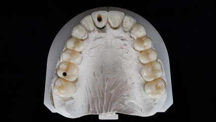 dental crowns and ceramic veneers on the model of the upper jaw top view on a black background © Dental Pro Content