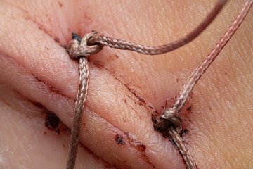 neat suture after appendicitis, close-up, macro photo of the suture and medical threads