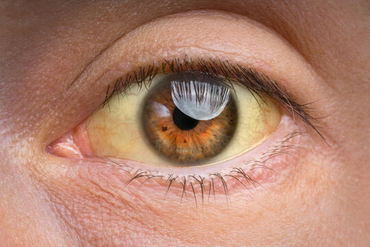 Jaundice Eye Images – Browse 796,765 Stock Photos, Vectors, and