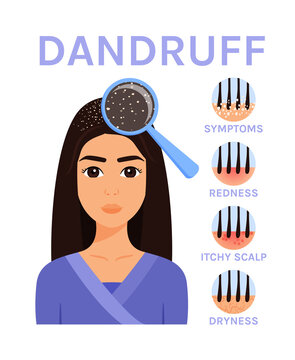 Beautiful Muslim Woman with Dandruff on Head. Zoom. Magnifying Glass and Hair Problems. Icons of Symptoms: Redness, Dryness, Itchy Scalp. Cartoon Color style. Vector image for Medical Beauty Design.