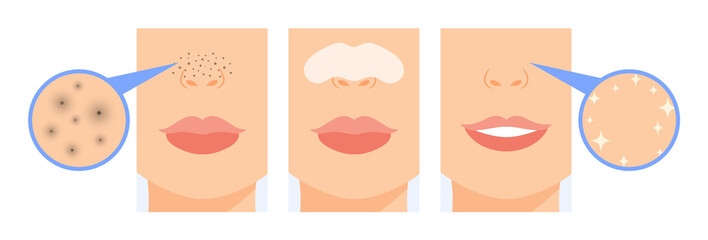 Black Dots on Female Nose. Dirty Skin and Clogged Pores. Woman Use Nose Strips. Before and After. Zoom. Close up view of Blackhead. Clean Skin and Happy Smile on Face. Cartoon style. Vector image.