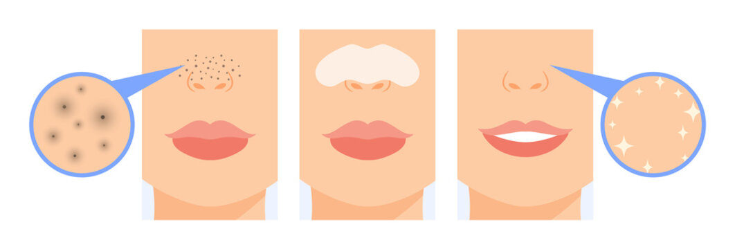 Black Dots on Female Nose. Dirty Skin and Clogged Pores. Woman Use Nose Strips. Before and After. Zoom. Close up view of Blackhead. Clean Skin and Happy Smile on Face. Cartoon style. Vector image.