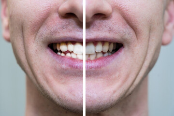 Man's smile before and after bleaching. Dental health (care) and whitening teeth