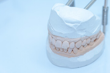 Gypsum jaw model. Dental care