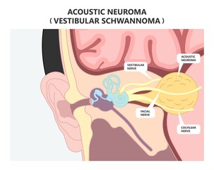 Acoustic neuroma tumor brain nerve inner ear loss cancer test MRI X-RAY  diagnosis meniere's genetic type 2 surgery Noise neuritis head BPPV Benign CT Scan