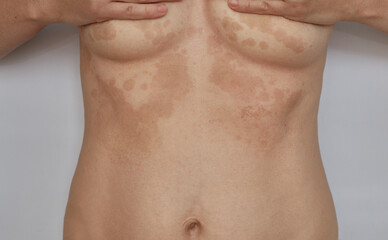 Shingles, Pityriasis on the skin. Skin diseases and dermatological problems.