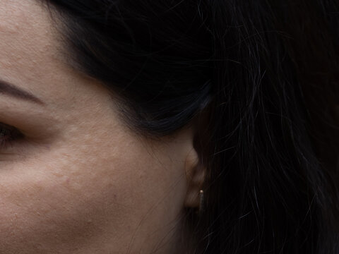 Papules after beauty injections on the face of a brunette. Closeup photo