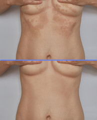 Shingles, pityriasis on the skin. Skin diseases and dermatological problems. Vertical version of...