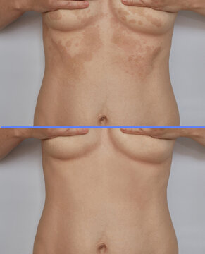 Shingles, pityriasis on the skin. Skin diseases and dermatological problems. Vertical version of the before after photo