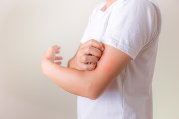 Man scratching itch with hands on the back of the hand / itching and skin problems / Health and...