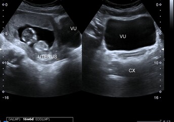 Ultrasound scan of a 16-week old fetus 
