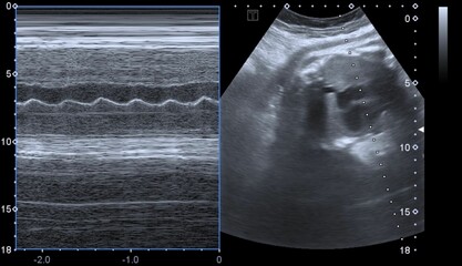 ultrasound of baby heartbeat