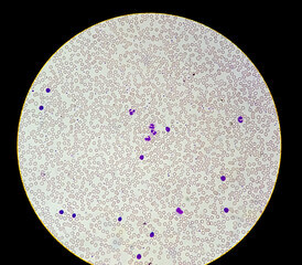 Neutrophil cell (white blood cell) in blood smear, analyze by microscope