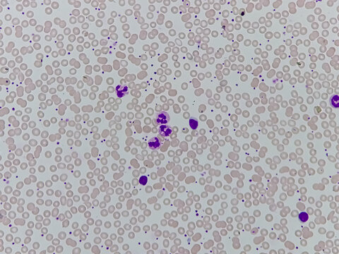 Neutrophil cell (white blood cell) in blood smear, analyze by microscope