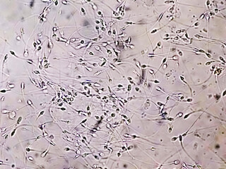 Polyzoospermia analyzed by microscope. Semen analysis normal sperm and morphology. Zoom image