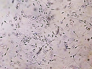 Polyzoospermia analyzed by microscope. Semen analysis normal sperm and morphology. Zoom image