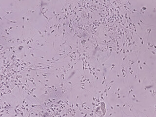 Polyzoospermia analyzed by microscope. Semen analysis normal sperm and morphology. Zoom image