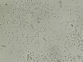 Polyzoospermia analyzed by microscope. Semen analysis normal sperm and morphology. Zoom image