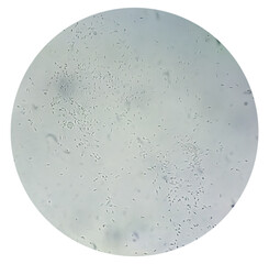 Semen analysis, sperm analysis on microscopic examination