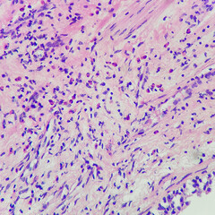 Camera photo of eosinophilic cystitis, showing several eosinophils in the subepithelium, magnification 400x, photograph through a microscope