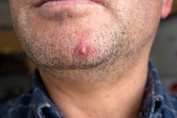 Obraz premium inflamed acne on the facial skin of a person, single large acne on the face,