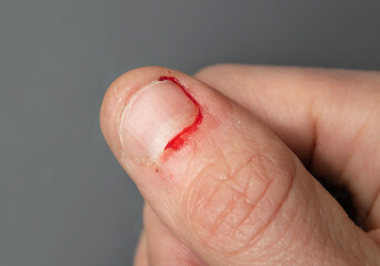 Bloody thumb from nail biting. Close up of adult female hand with fresh chewed fingernail and small...