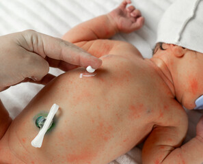 diaper rash in babies and care for them from the first days of birth