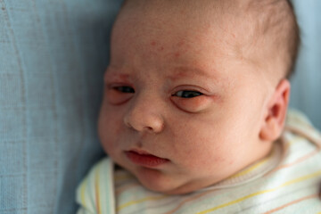 Awake Newborn Baby Face Portrait Acne Allergic Irritations Early Days Grimace Crying On Blue Background. Child Start Minutes Of Life. Infants, Childbirth, First Moments Of Borning, Beginning Concept.