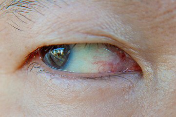 Close-up of right eye of Asian man with eye irritation problem