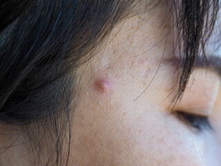 Inflamed pimples popped up on a young woman's face.