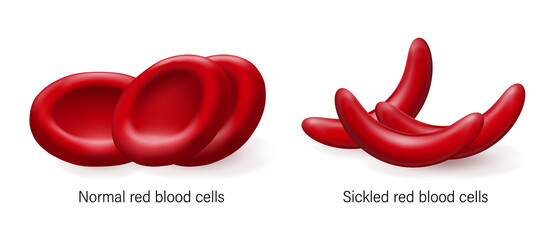 Sickle cell disease. Normal red blood cells and sickled red blood cells.