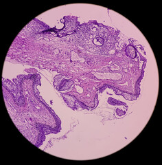 Eye conjunctival growth biopsy: Rhinosporidiosis, microscopic show large thick walled sporangia...