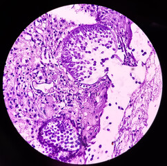 Eye conjunctival growth biopsy: Rhinosporidiosis, microscopic show large thick walled sporangia with many endospores accompanied, mixed inflammatory infiltrate, focus view.