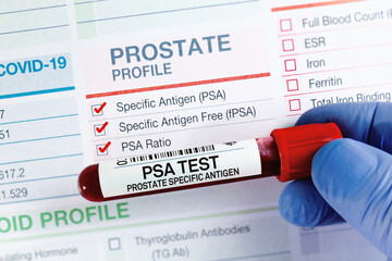 Blood sample for analysis of PSA Prostate Specific Antigen profile test in laboratory. Blood tube...