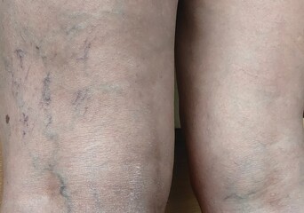 Portrait showing the varicose veins on the legs of woman, skin problem, concept health care.