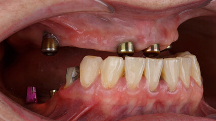 four gingiva formers on the upper jaw. side view