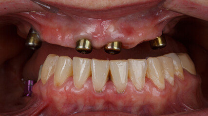 four gingiva formers in the upper jaw after implantation © Dental Pro Content