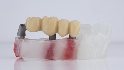 temporary dental bridge prosthesis for four teeth with a bar on a white background