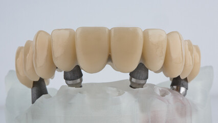 excellent dental prosthesis of the upper jaw with large teeth on the bar and model, shot on a white background © Dental Pro Content