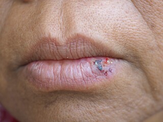 Herpes virus infections on the lips. closeup photo, blurred.